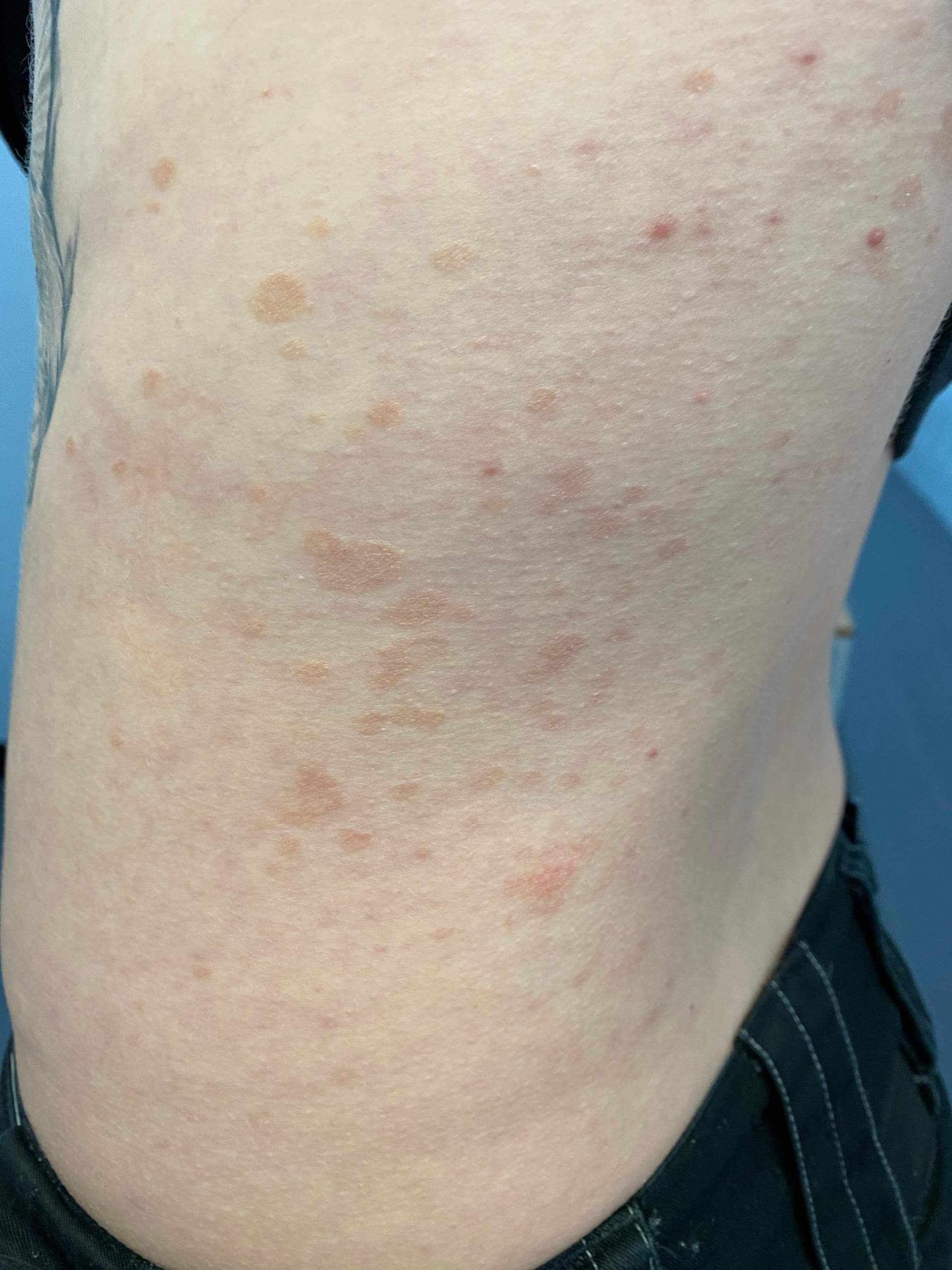 Was sind das für merkwürdige Flecken auf meinem Rücken? (Dermatologie)