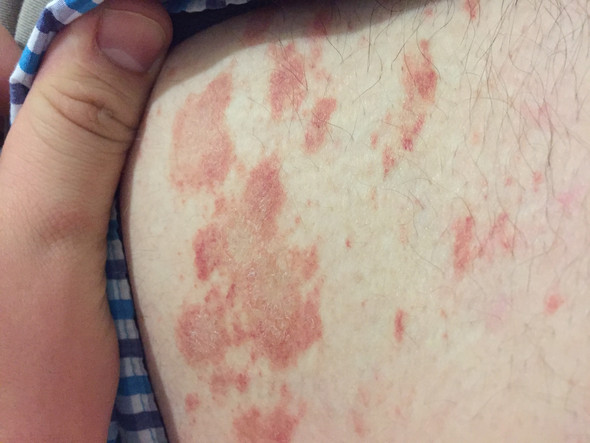 Was Sind Das Fur Rote Flecken Was Dies Jemand Haut Was Sind Das Fur Rote Flecken Was Dies Jemand Haut