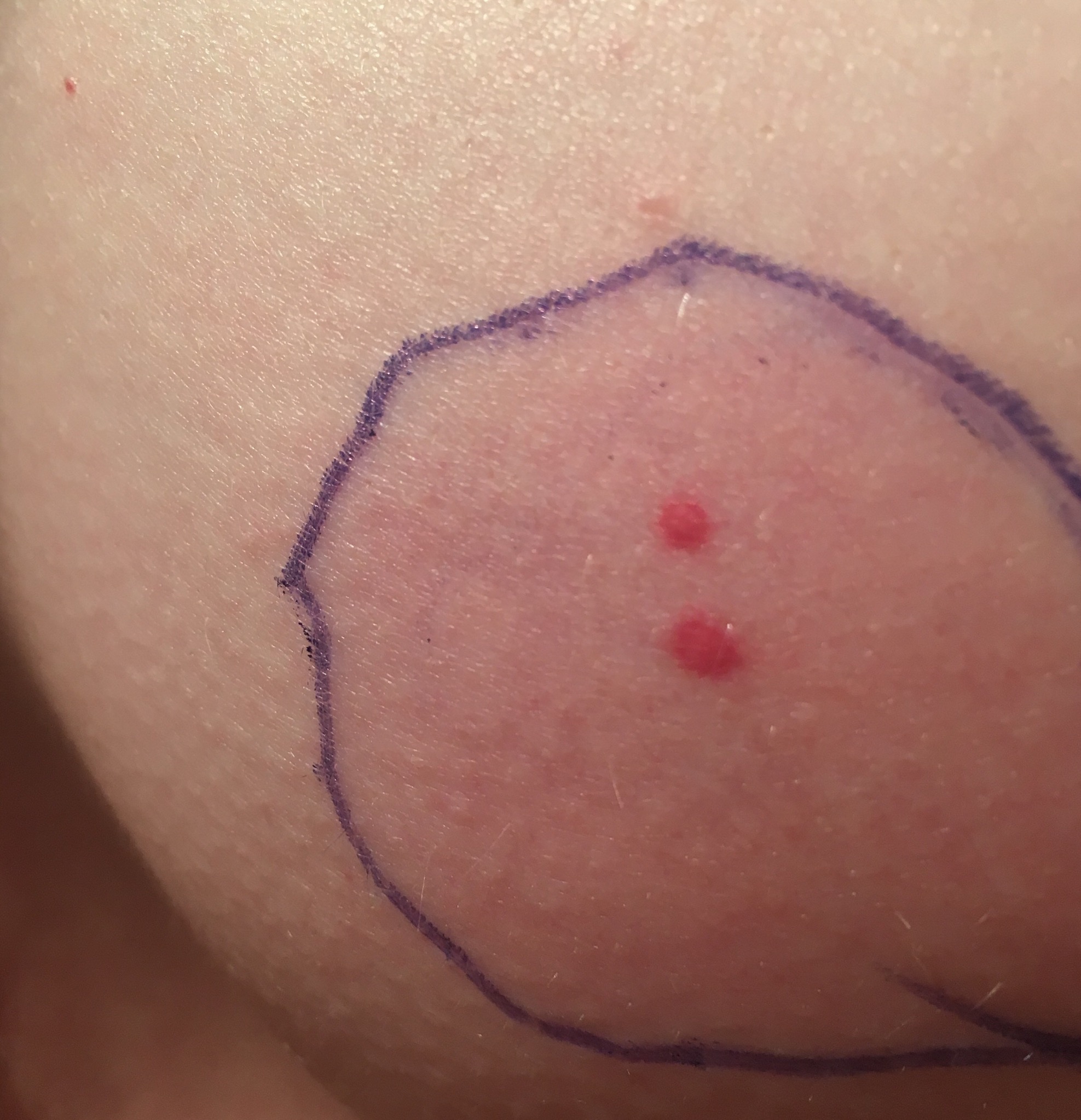 Penis Roter Fleck Rote Flecken Auf Der Eichel 2019 12 28 Penis Roter Fleck Rote Flecken Auf Der Eichel 2019 12 28