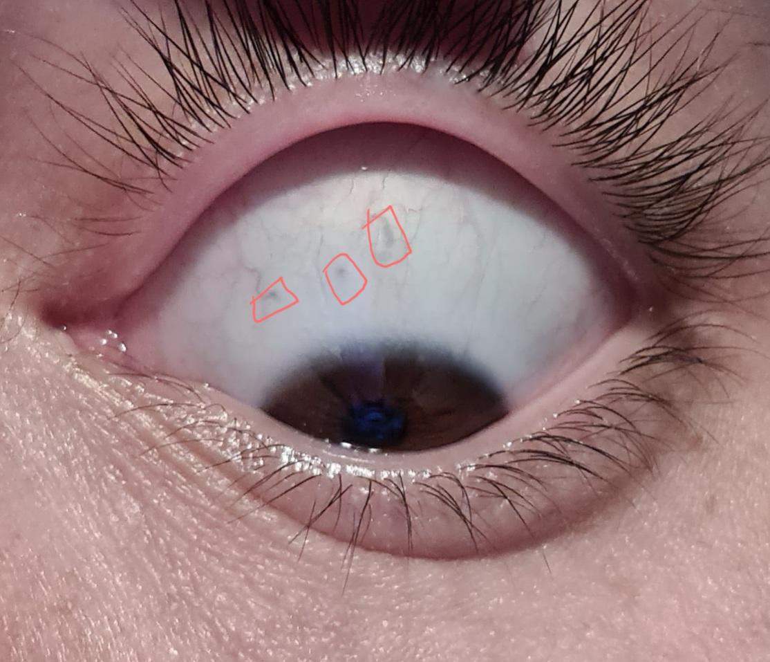 Was sind das genau für graue flecken im augenweiss? (Augen) Was sind das genau für graue flecken im augenweiss? (Augen)