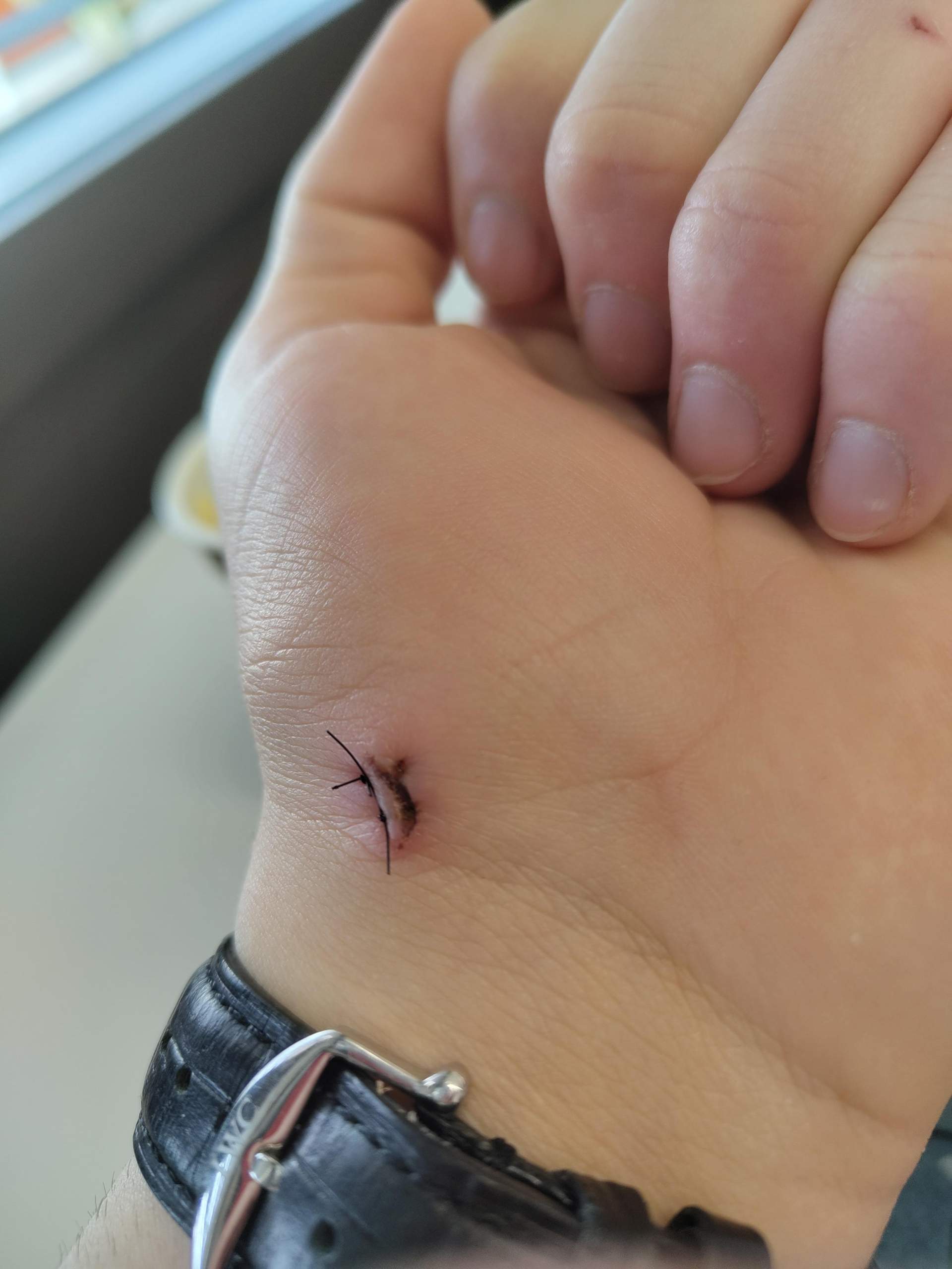 narbe nach knie op bilder