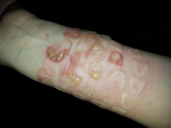 Was Tun Bei Dieser Verbrennung Hilfe Was Tun Bei Dieser Verbrennung Hilfe