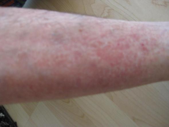 Seit Einem Jahr Wirkt Meine Haut Am Schienbein Entzundet Und Juckt Bei Drei Arzten War Ich Schon Was Kann Ich Noch Tun Seit Einem Jahr Wirkt Meine Haut Am Schienbein Entzundet Und Juckt Bei Drei Arzten War Ich Schon Was Kann Ich Noch Tun