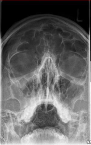 Was Tun Gegen Chronische Sinusitis Allergie Nasennebenhohlenentzundung Pollenallergie Was Tun Gegen Chronische Sinusitis Allergie Nasennebenhohlenentzundung Pollenallergie