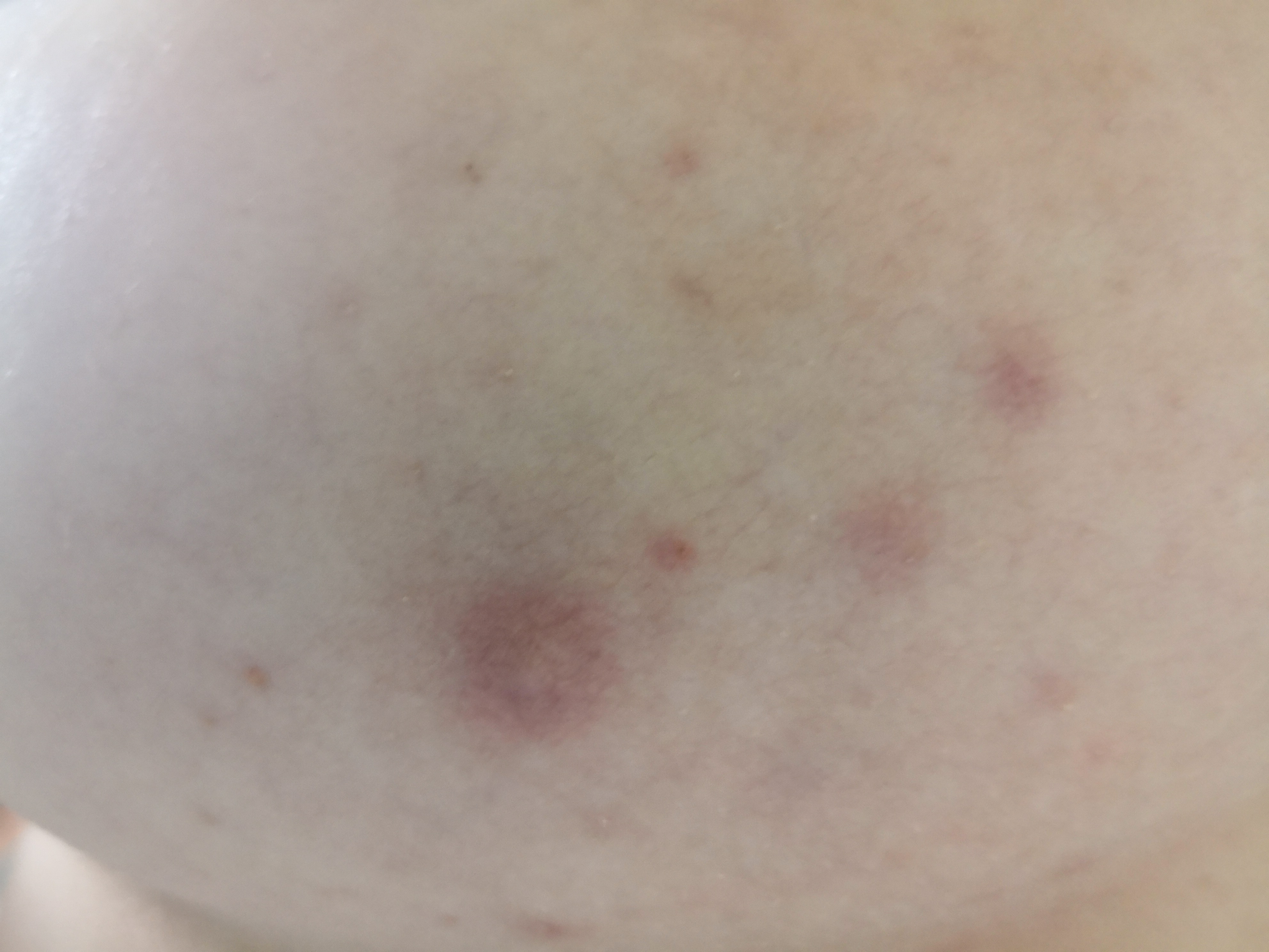 Was tun gegen sehr schlimme Hautunreinheiten auf der Brust? (Pickel Was tun gegen sehr schlimme Hautunreinheiten auf der Brust? (Pickel