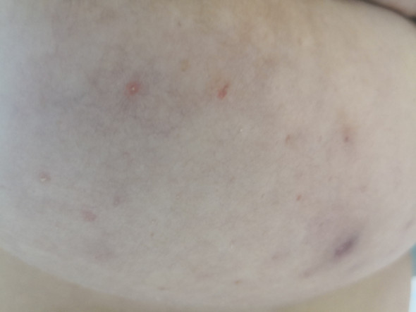 Was Tun Gegen Sehr Schlimme Hautunreinheiten Auf Der Brust Pickel Ausschlag Hautprobleme Was Tun Gegen Sehr Schlimme Hautunreinheiten Auf Der Brust Pickel Ausschlag Hautprobleme