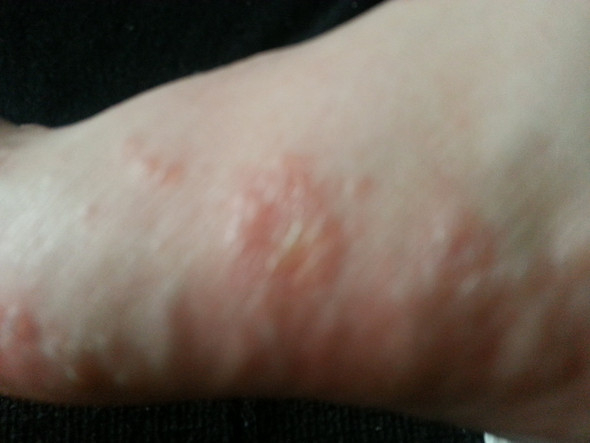 Wasserblaschen An Hande Und Fussen Was Ist Das Jucken Fusspilz Blaschen Wasserblaschen An Hande Und Fussen Was Ist Das Jucken Fusspilz Blaschen