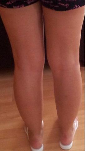 Wassereinlagerung Beine Wassereinlagerungen Wassereinlagerung Beine Wassereinlagerungen