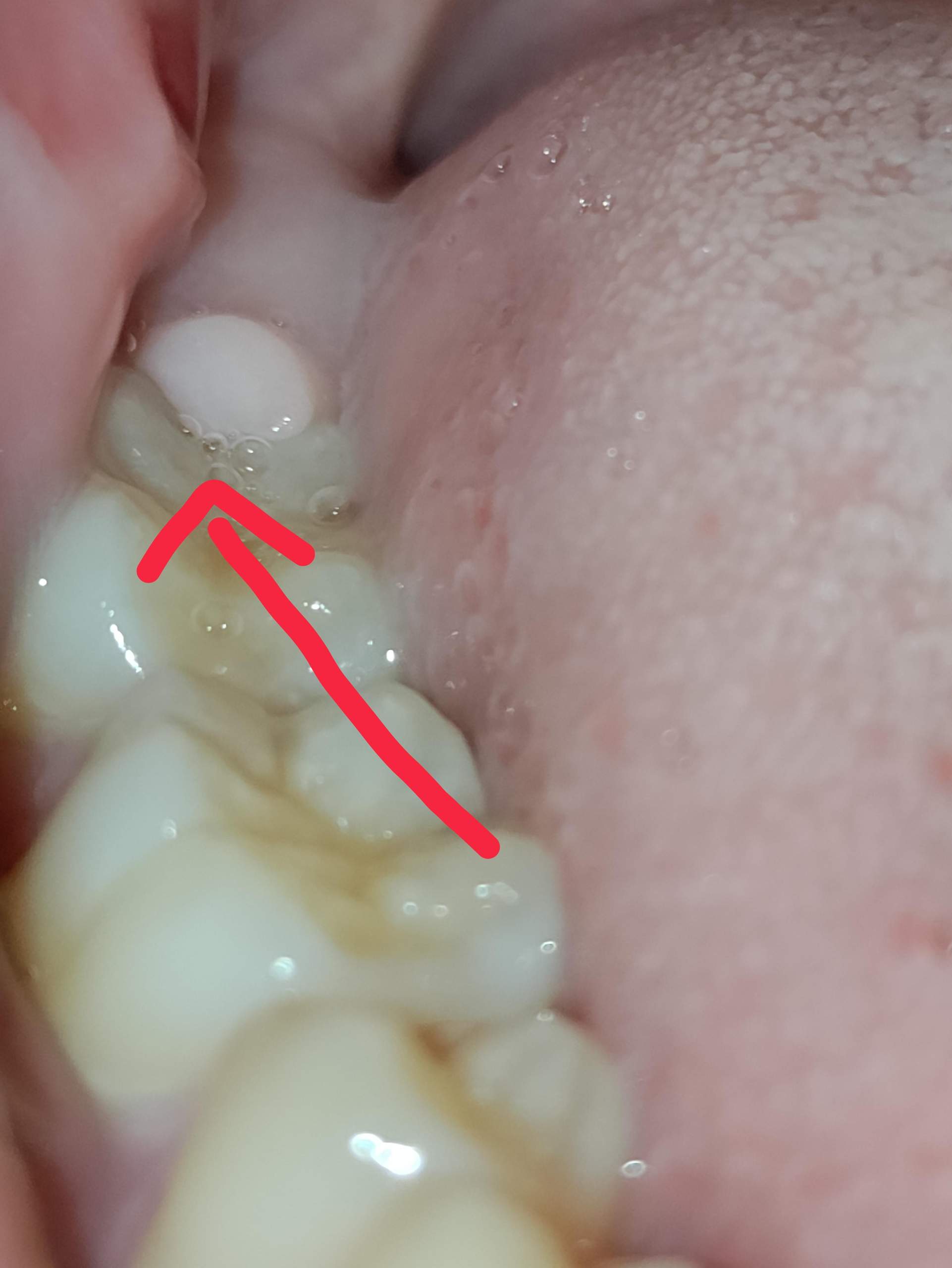 Weiße Beule hinter dem Backenzahn? (Zähne, Mund, Zahnfleisch)