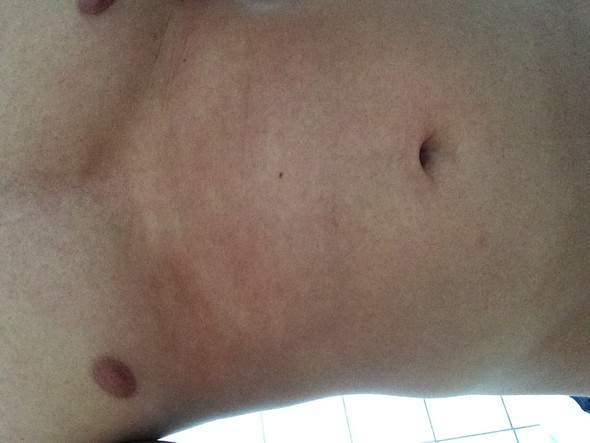 Weisse Flecken Nach Sonnen Kann Das Ein Pilz Sein Haut Hautpilz Weisse Flecken Nach Sonnen Kann Das Ein Pilz Sein Haut Hautpilz