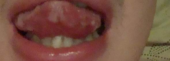 Weiße Flecken unter und auf der Zunge?