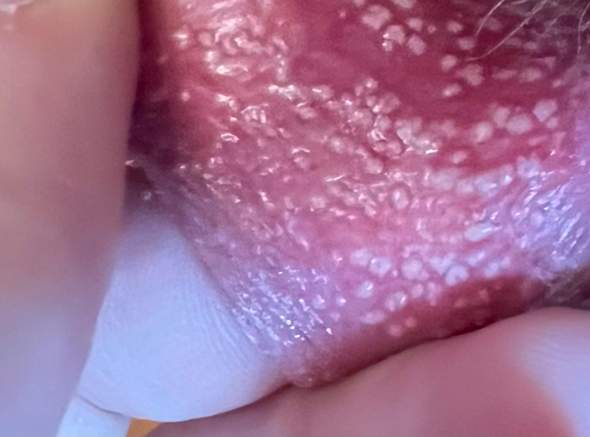 Weiße Punkte an der Schamlippe. Was ist das? (intimbereich, Schamlippen) Weiße Punkte an der Schamlippe. Was ist das? (intimbereich, Schamlippen)