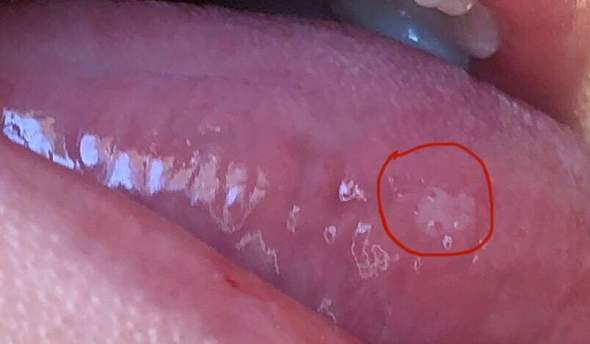 Weiße Stelle am Zungenrand, was kann das sein?