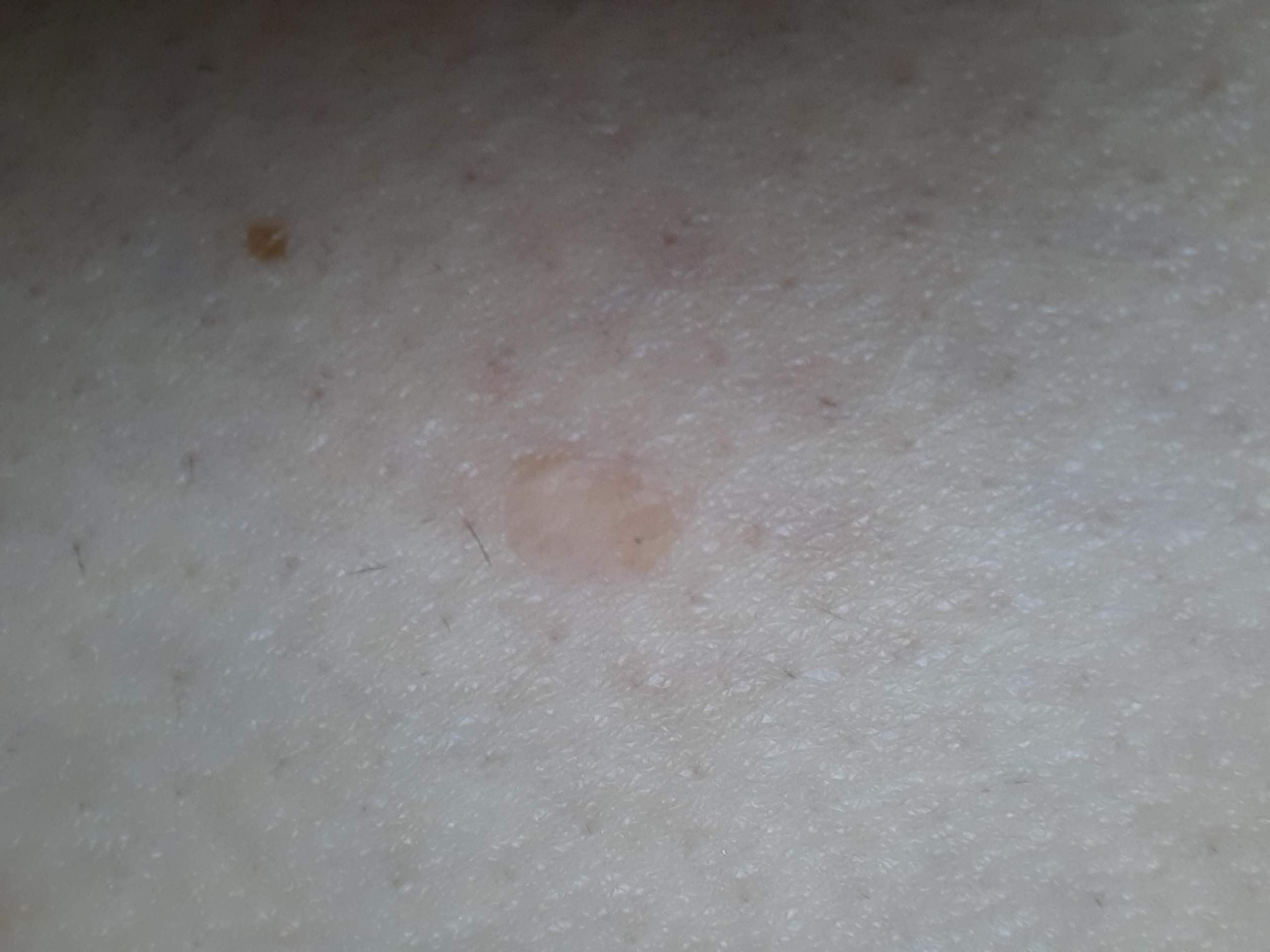 WeiÃer Hautkrebs? (Haut, Muttermal)