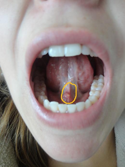 15+ Pickel Auf Der Zunge Kind Pictures