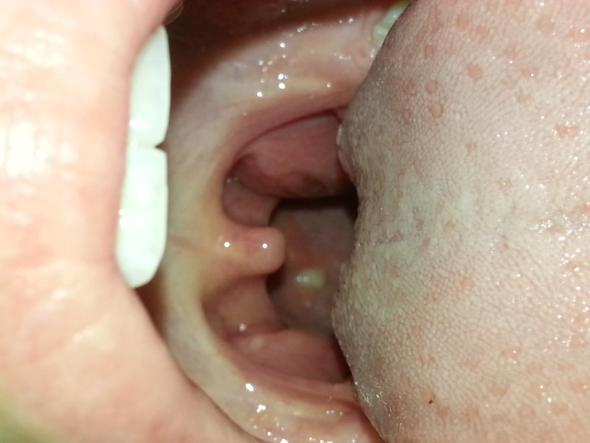 Weisser Punkt Im Rachen Husten Halsschmerzen Weisser Punkt Im Rachen Husten Halsschmerzen