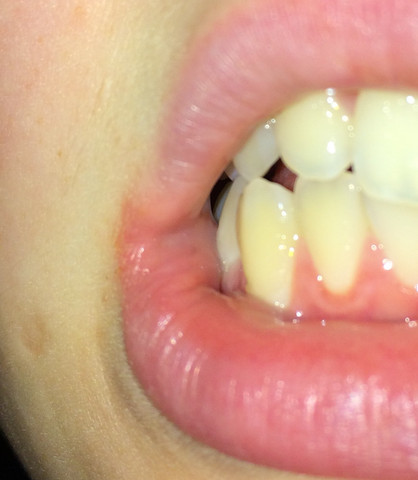 Weisser Rand Unterm Zahn Zahne Zahnarzt Mund