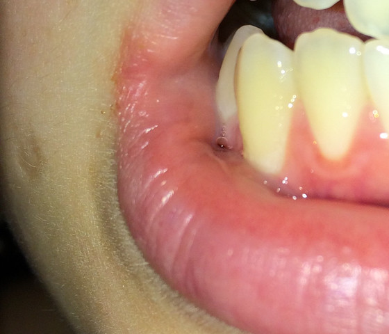 Weisser Rand Unterm Zahn Zahne Zahnarzt Mund