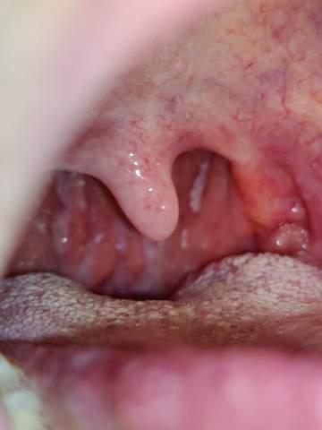 Streptokokken Tonsillitis Deximed