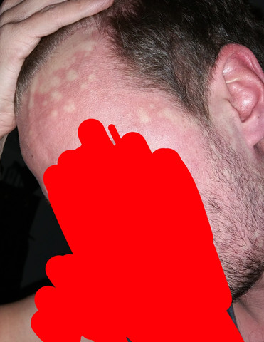 Vorhaut weiße punkte Weiße kl.