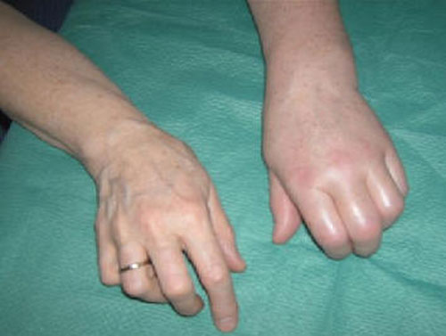 Welche Chancen habe ich noch mit einer &quot;Diagnose&quot; CRPS (Morbus Sudeck