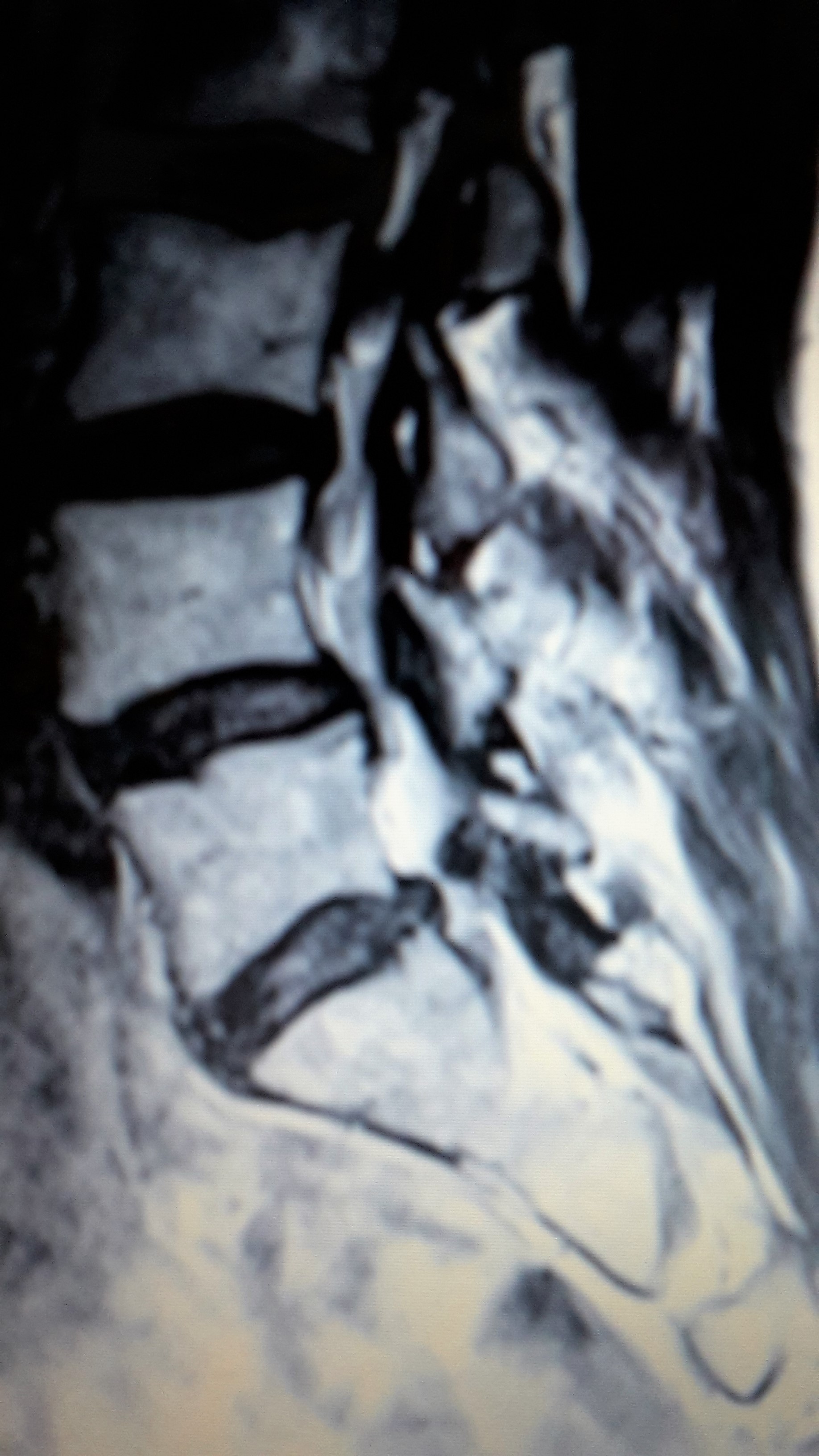 Wer kann mir diese MRT Aufnahmen der LWS auswerten ? (Wirbelsäule, Befund) Wer kann mir diese MRT Aufnahmen der LWS auswerten ? (Wirbelsäule, Befund)