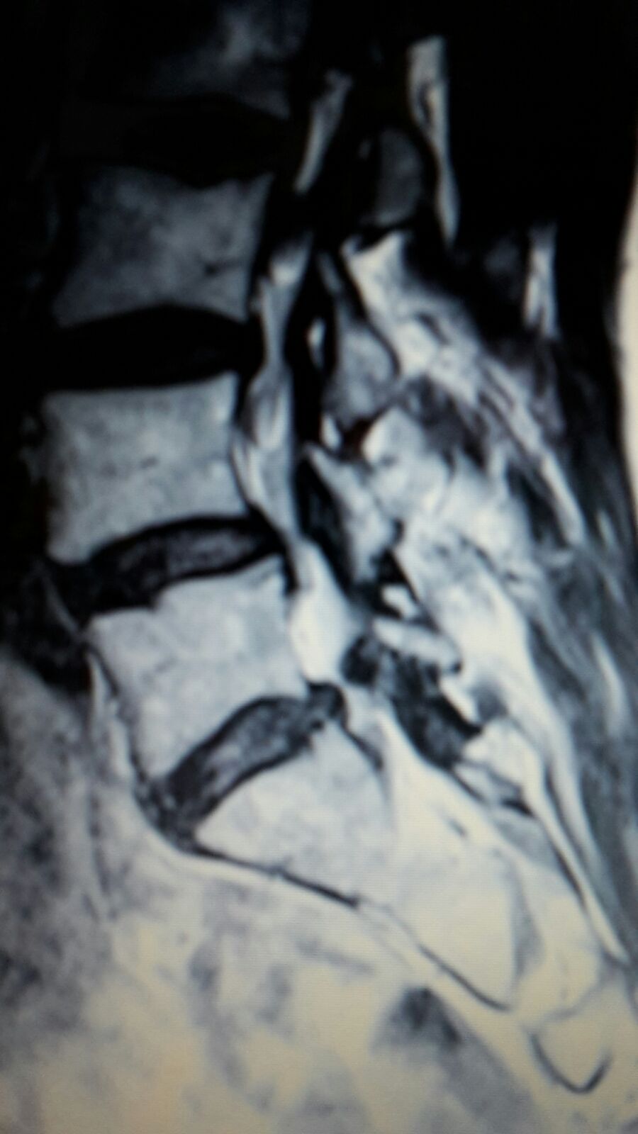 Wer kann mir diese MRT Aufnahmen der LWS auswerten ? (Wirbelsäule, Befund) Wer kann mir diese MRT Aufnahmen der LWS auswerten ? (Wirbelsäule, Befund)