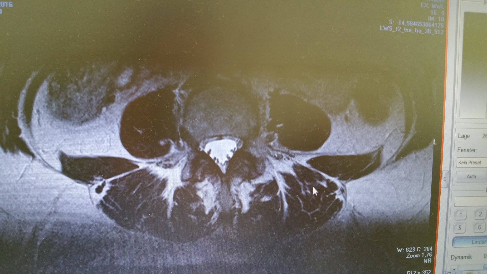 Wer kann mir diese MRT Aufnahmen der LWS auswerten ? (Bandscheibe Wer kann mir diese MRT Aufnahmen der LWS auswerten ? (Bandscheibe