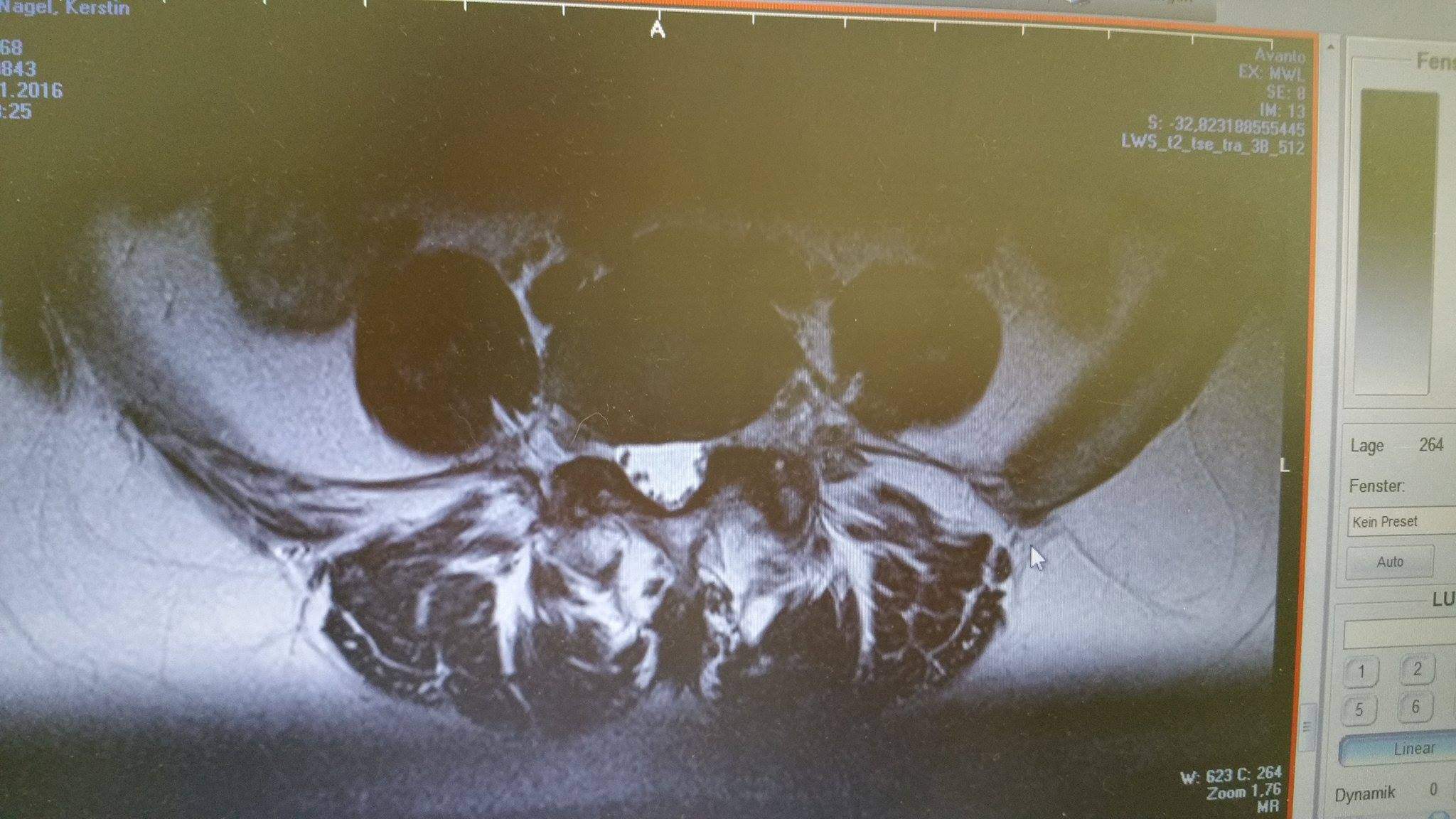 Wer kann mir diese MRT Aufnahmen der LWS auswerten ? (Bandscheibe Wer kann mir diese MRT Aufnahmen der LWS auswerten ? (Bandscheibe