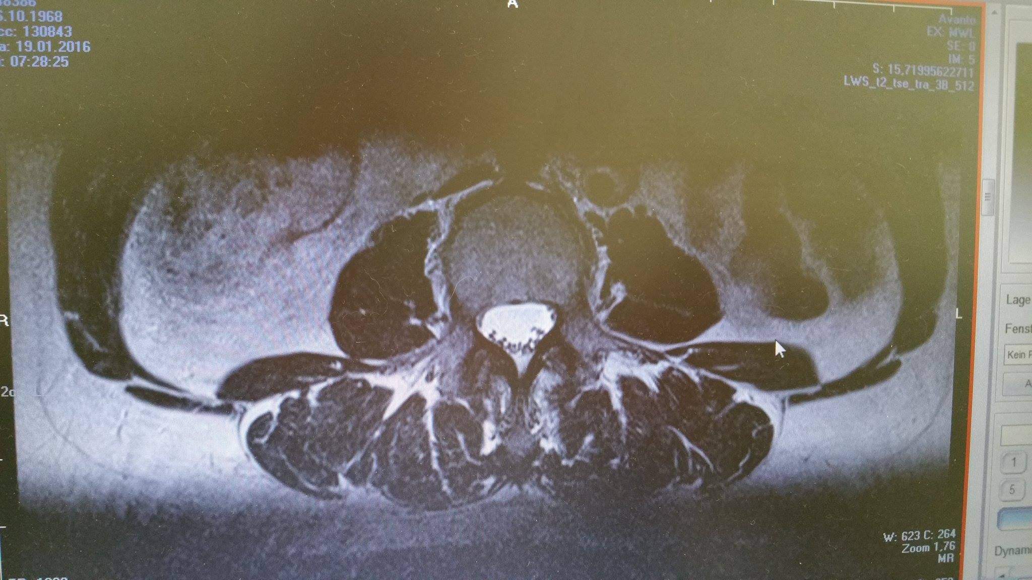 40+ Mrt lws bilder auswerten , Wer kann mir diese MRT Aufnahmen der LWS auswerten ? (Bandscheibe