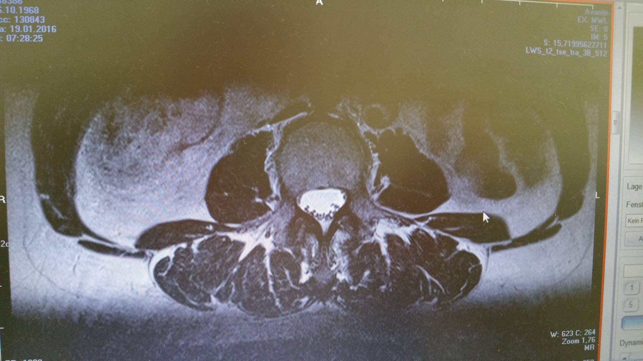 Wer kann mir diese MRT Aufnahmen der LWS auswerten ? (Bandscheibe Wer kann mir diese MRT Aufnahmen der LWS auswerten ? (Bandscheibe