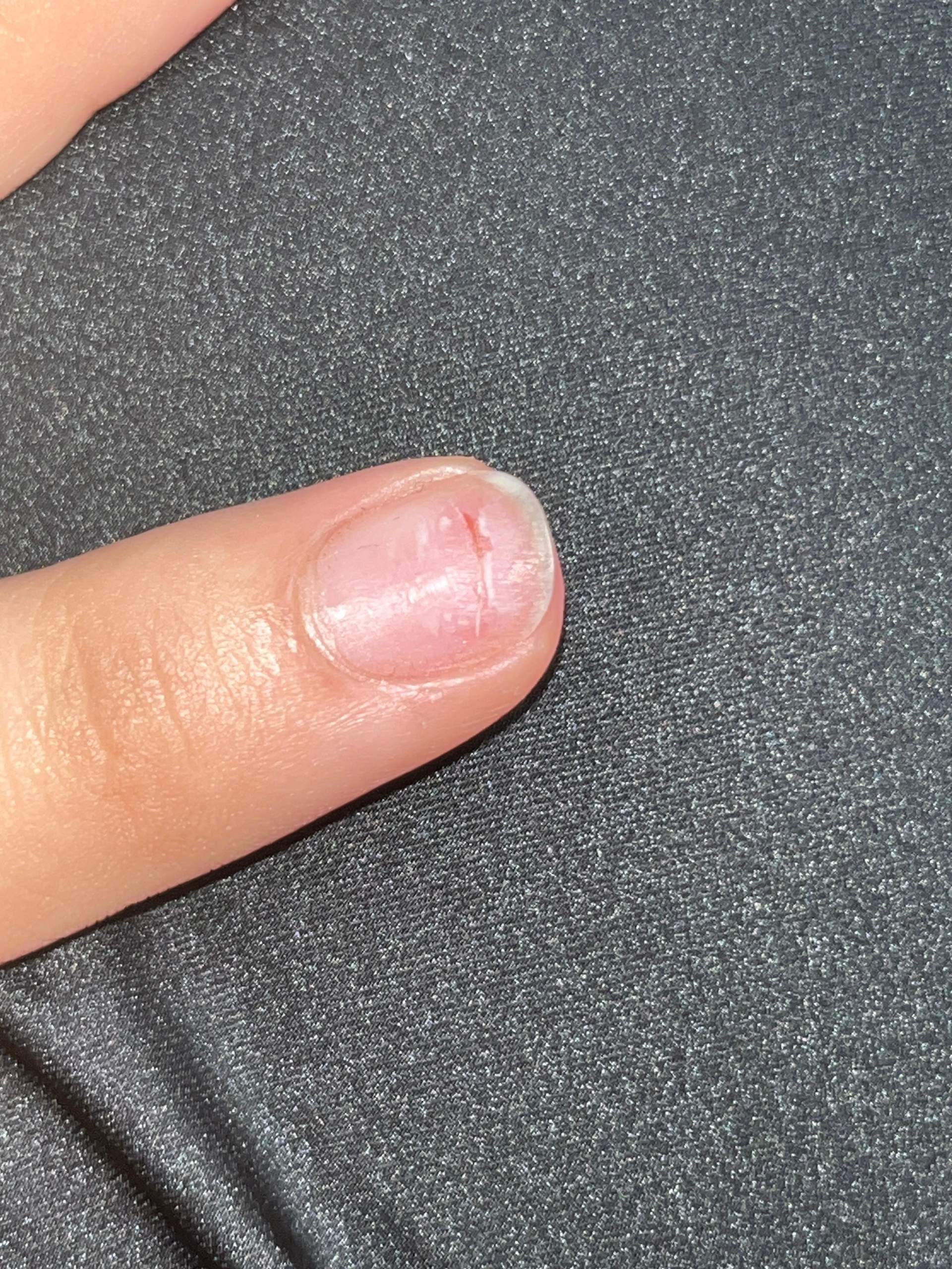 Wie behandle ich einen Riss mitten auf dem Nagel? (Schmerzen ...