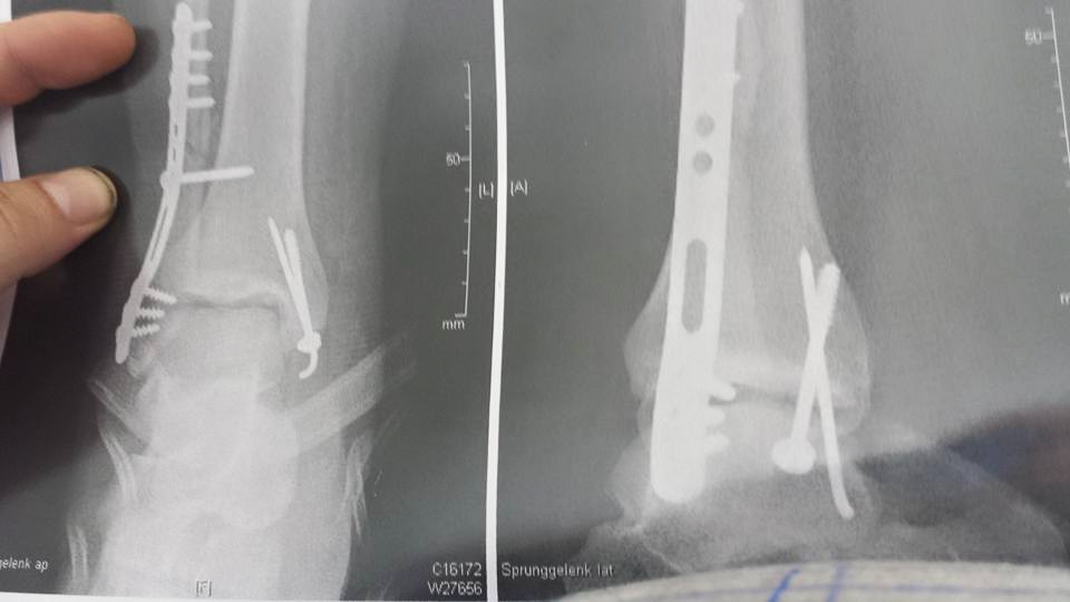 Die Schwangerschaft 5 Wochen tut die Lende rechts weh
