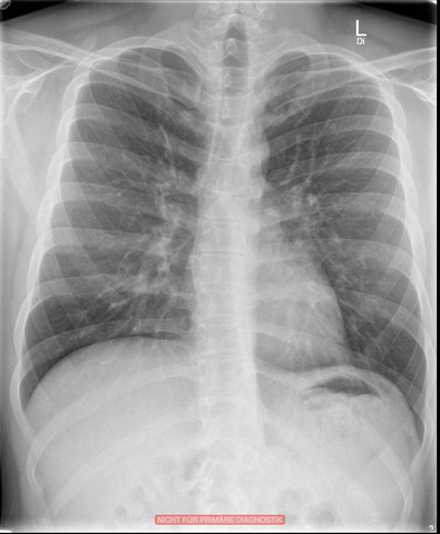 Thorax Röntgenaufnahme - (Röntgen, Skoliose, Thorax)