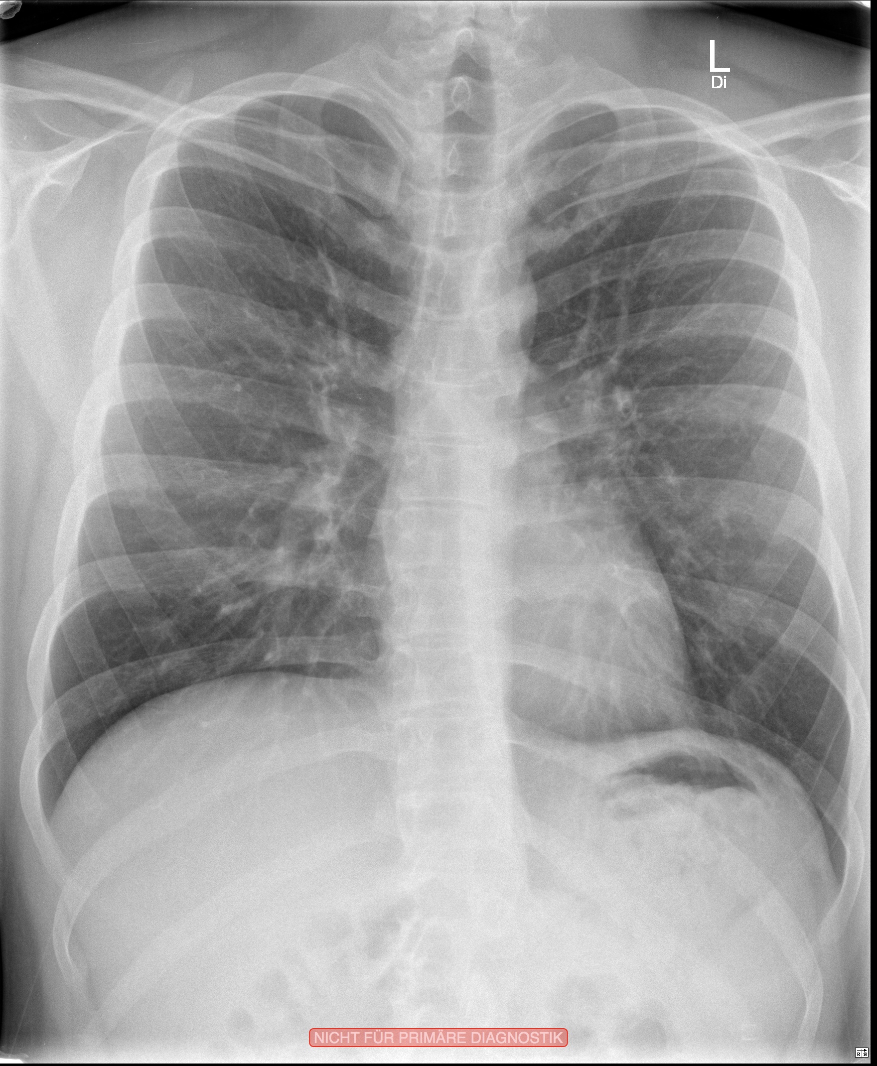 Wie hoch ist der Grad meiner Skoliose? (Röntgen, Thorax)