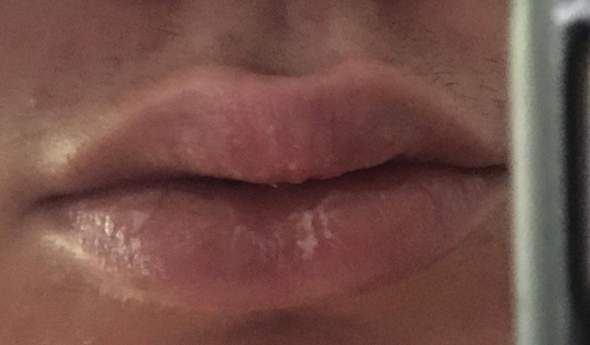 Wie Kann Ich Diese Lippen Heilen Hautpflege Lippe Wundheilung