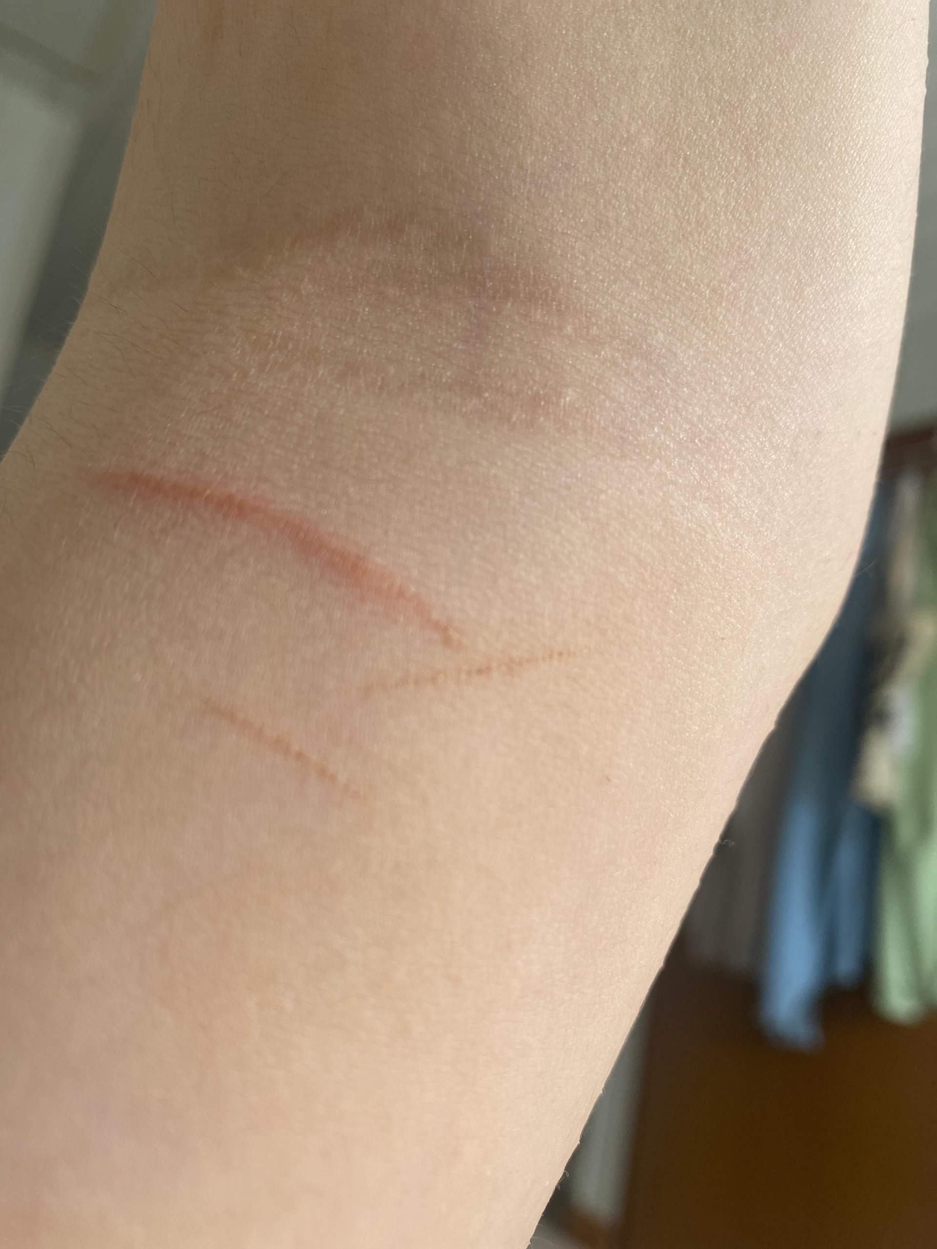 Wie lange dauert es ungefähr bis es verheilt ist (Bild)? (Gesundheit, Narben, Dauer) Wie lange dauert es ungefähr bis es verheilt ist (Bild)? (Gesundheit, Narben, Dauer)