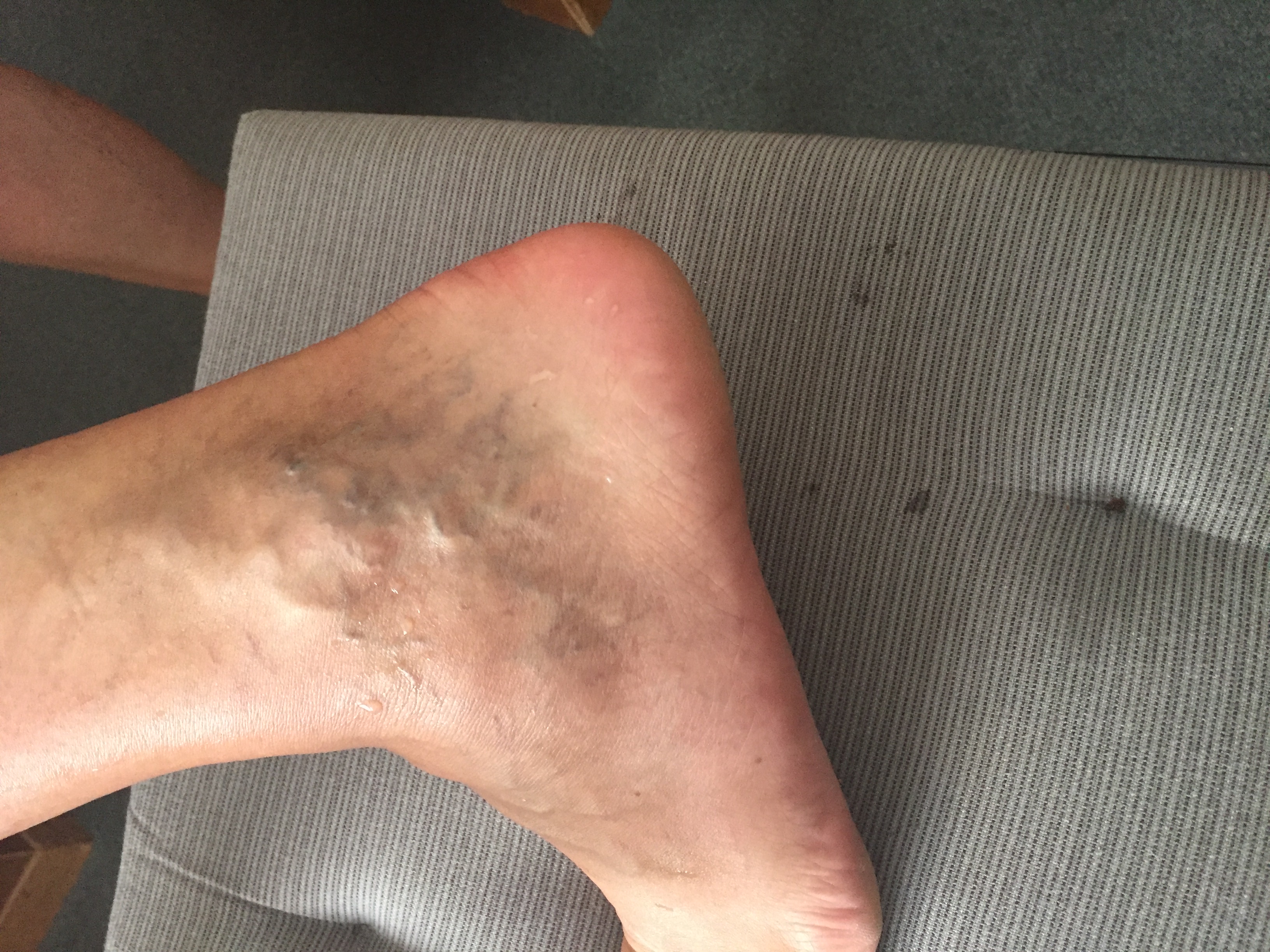 Wie sieht’s aus? (Venen)