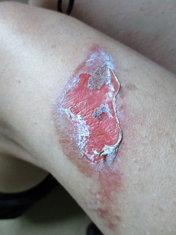 Verbrühung - (Haut, Wunde, Dermatologie)