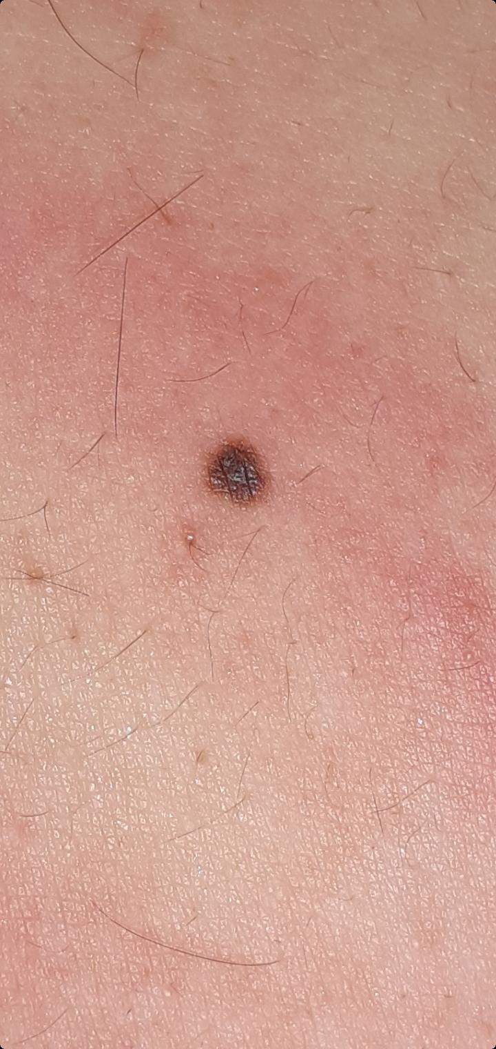 wie würdet ihr dieses muttermal anhand der abcde regel bewerten ...