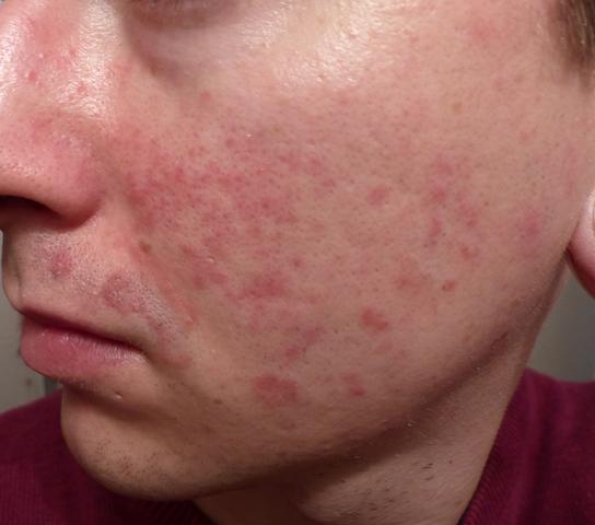 Wiederkehrender Hautausschlag im Gesicht (Dermatologie)