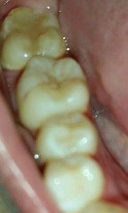 Wieso verschieben sich Zähne nach Zahnspange?!?