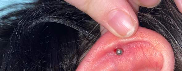 - (Entzündung, Piercing, Wildfleisch)