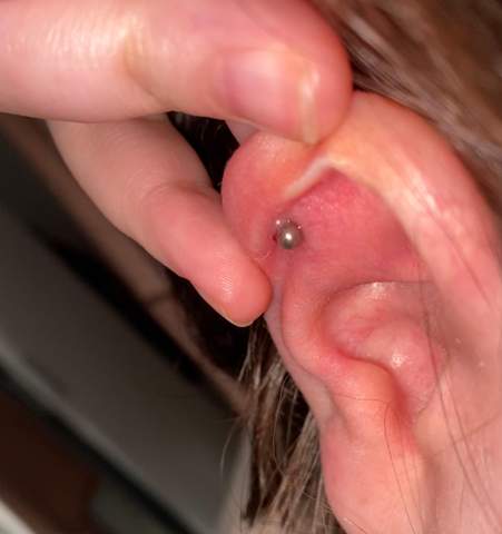 - (Entzündung, Piercing, Wildfleisch)