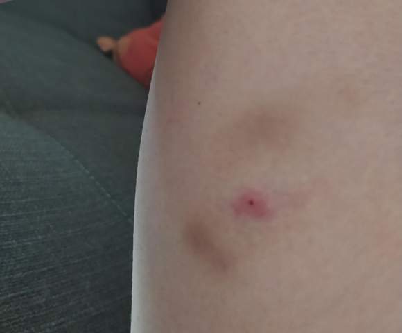 - (Haut, Zeckenbiss)