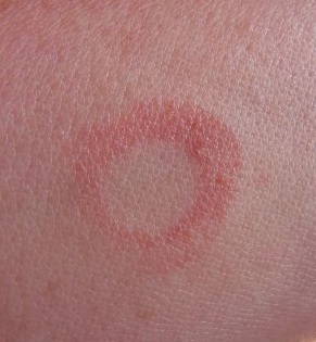 Insektenstich entzündet bilder Insektenstich entzündet bilder