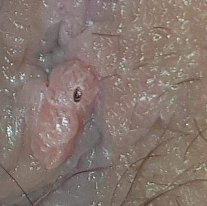 Penis fibrom Fibrous pseudotumor
