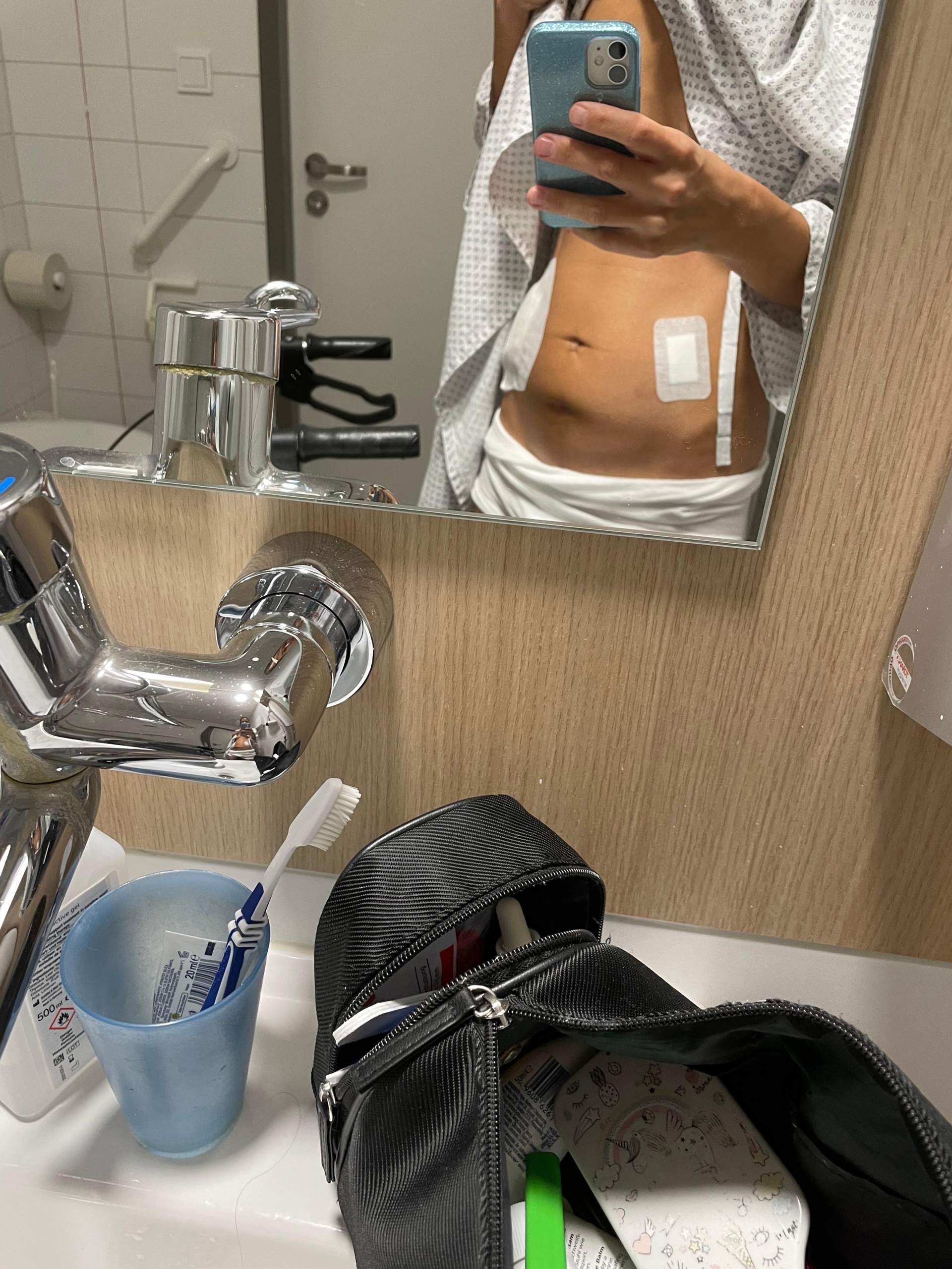 Wulst nach Bauch OP? (endometriose, Katheter)