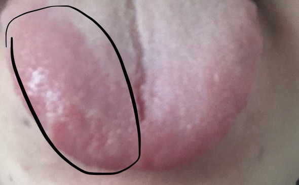 Wunde Auf Der Zunge Wunde Auf Der Zunge