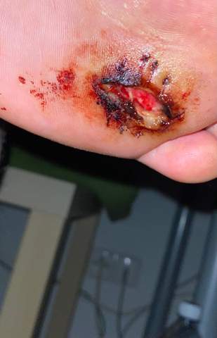 Wunde Offen Nach Faden Ziehen Haut Wunde Offen Nach Faden Ziehen Haut
